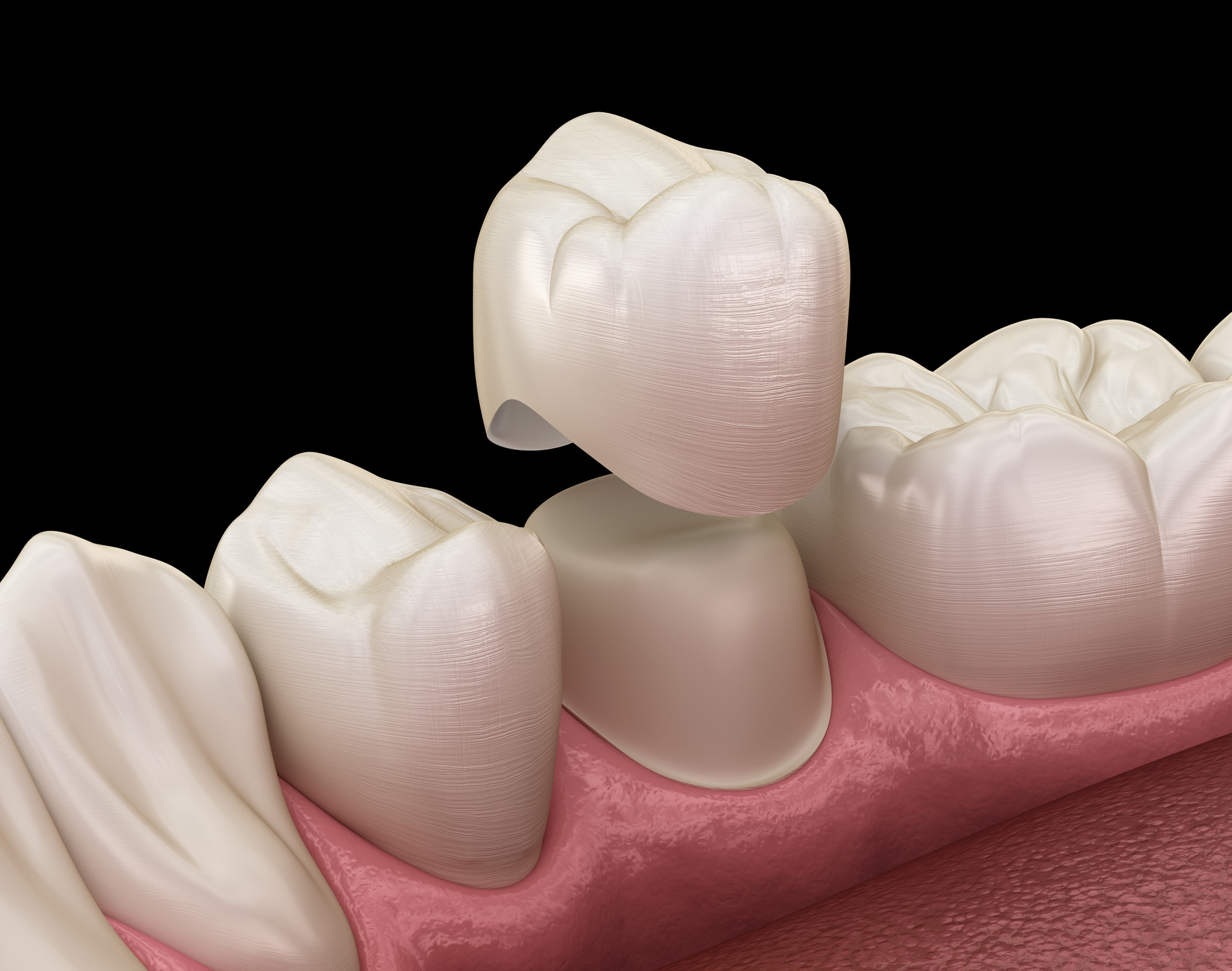 Cerec Same-day dental crowns in Fargo ND