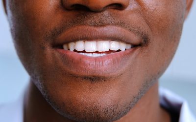 Teeth Whitening for Sensitive Teeth in Fargo ND