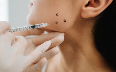 Botox in Dentistry – What You Need to Know Before Your First Appointment in Fargo, ND