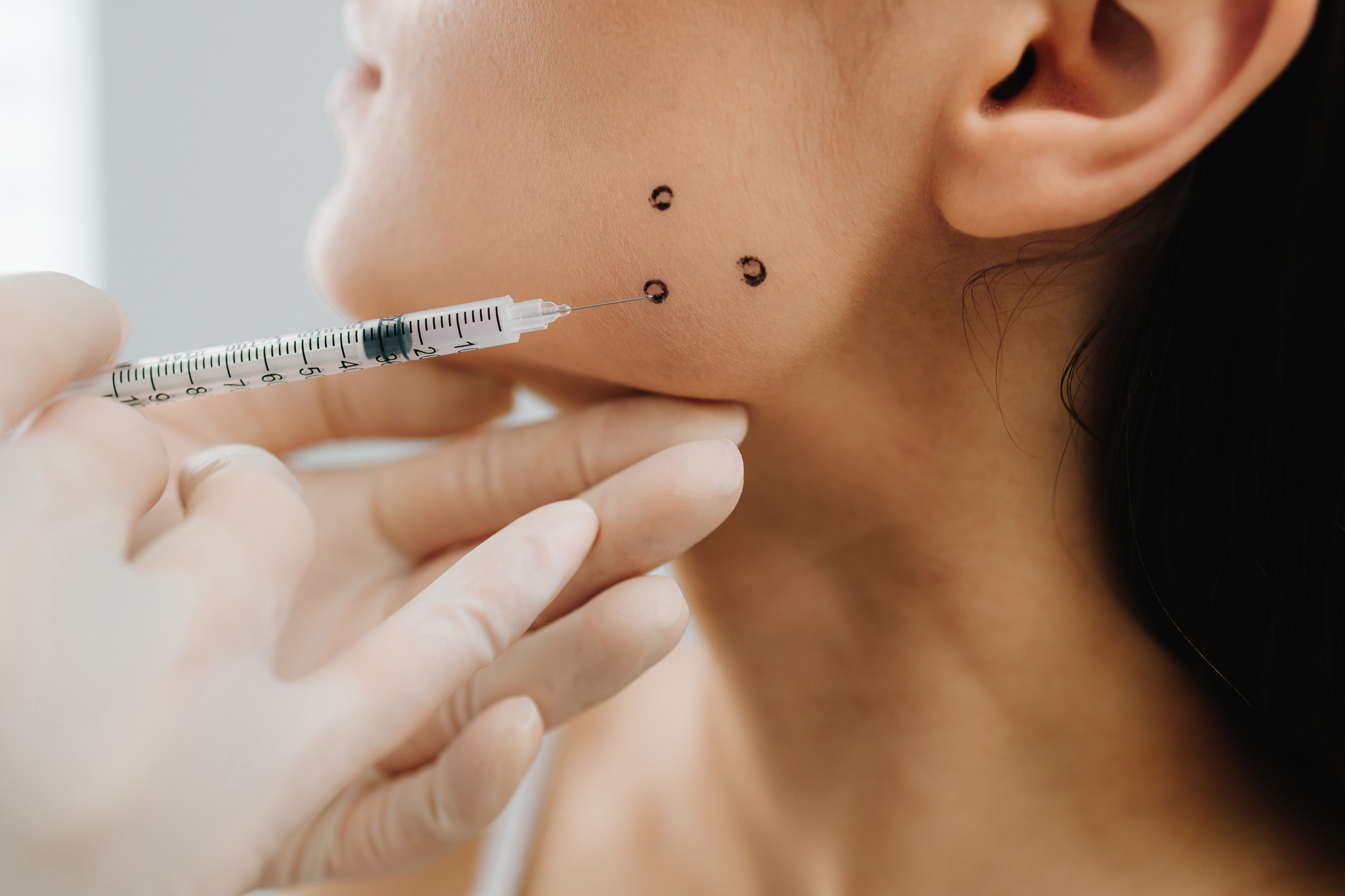 Dental botox at Sheyenne Dental in Fargo ND