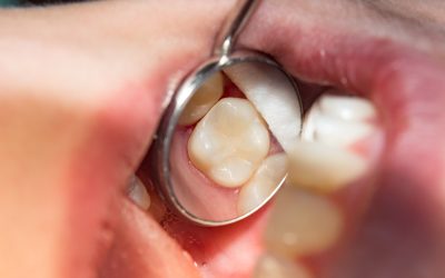 Tooth-Colored Fillings vs. Silver Fillings: What’s the Difference?