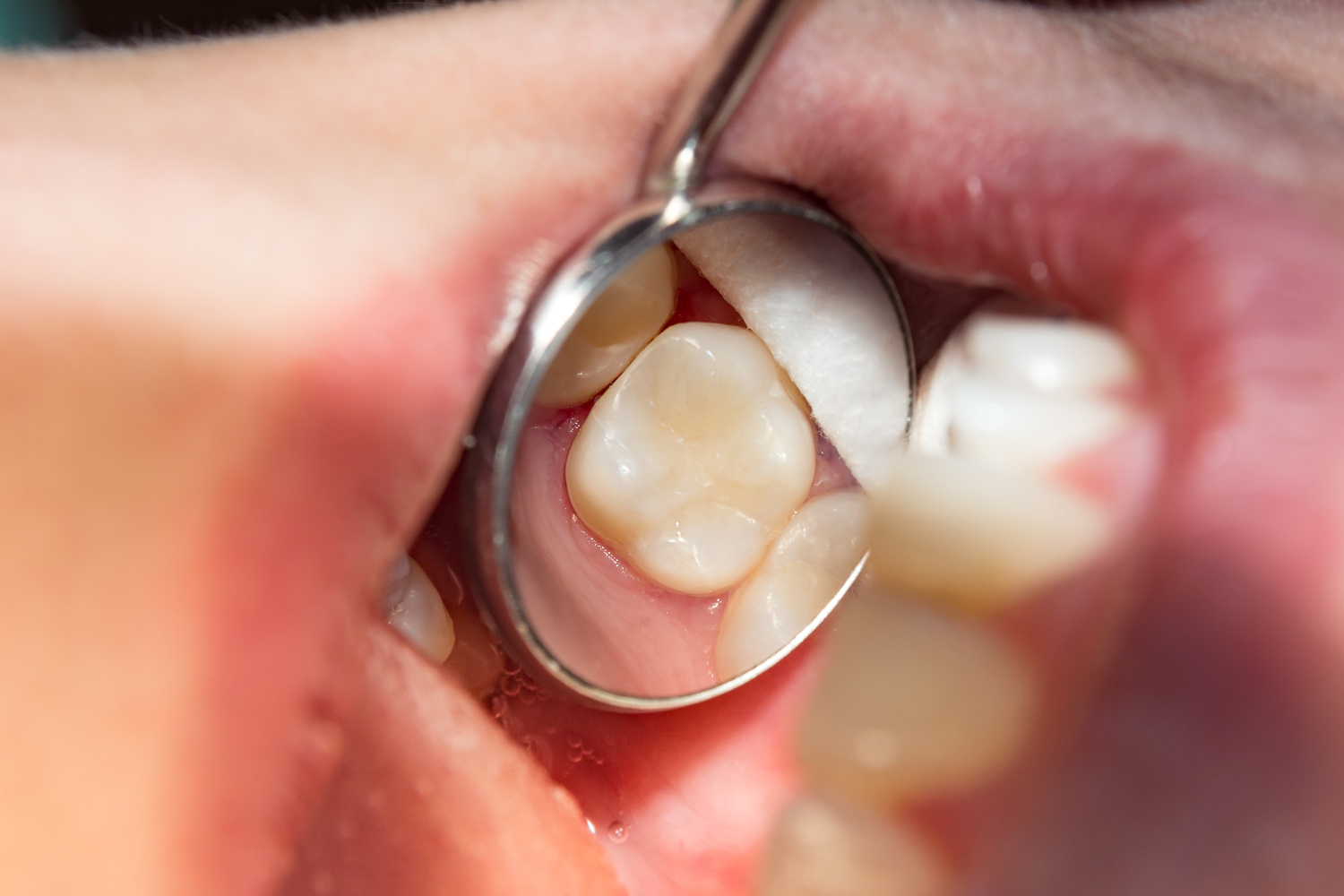 Patient with a tooth colored filling learns the difference between tooth colored and silver fillings at Sheyenne Dental